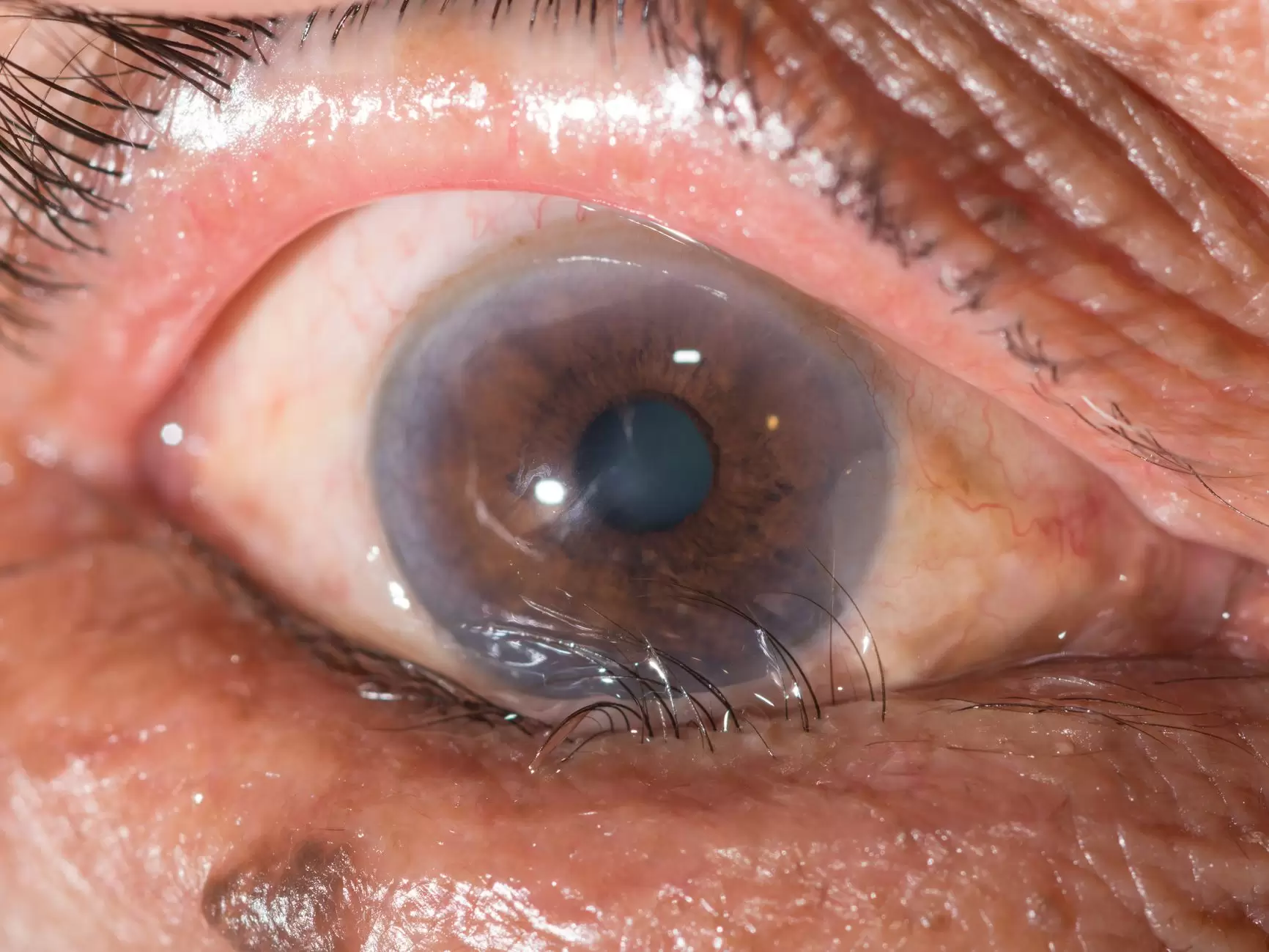 انتروپیون چشم چه علائمی دارد و چگونه درمان می‌شود؟